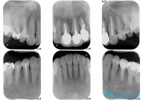 虫歯がたくさん　歯肉深くにまで及んだ虫歯の治療の治療前