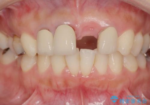 [前歯の審美回復] 前歯の入れ歯をオールセラミックブリッジへの治療中
