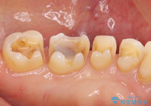[セラミックインレー] 銀歯を白くする虫歯治療の治療中