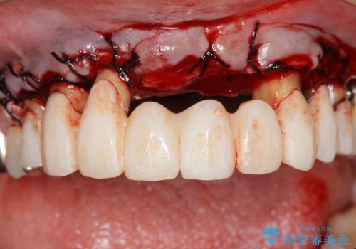[歯周ポケット除去]  歯周病を改善してからの前歯部ブリッジの治療中