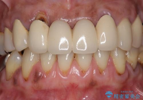 [歯周ポケット除去]  歯周病を改善してからの前歯部ブリッジの治療前