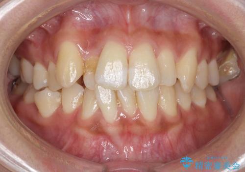 抜歯を最小限に　親知らずを生かす矯正　すれ違い咬合　の症例 治療前