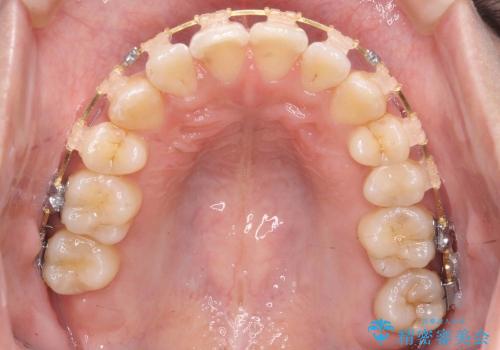 抜歯を最小限に　親知らずを生かす矯正　すれ違い咬合　の治療中