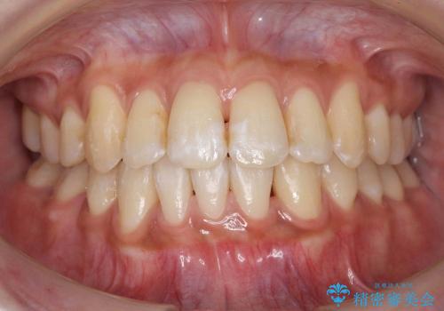 抜歯を最小限に　親知らずを生かす矯正　すれ違い咬合　の治療後