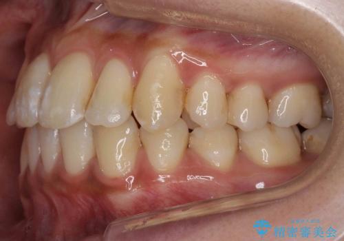 抜歯を最小限に　親知らずを生かす矯正　すれ違い咬合　の治療後