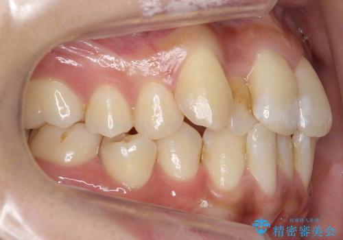 抜歯を最小限に　親知らずを生かす矯正　すれ違い咬合　の治療前