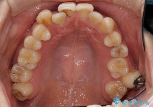 抜歯を最小限に　親知らずを生かす矯正　すれ違い咬合　の治療前