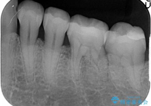 [セラミックインレー] 銀歯を白くする虫歯治療の治療後