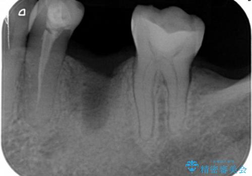 40代女性　奥歯のインプラント治療①～抜歯～の治療後