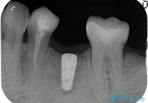 40代女性　奥歯のインプラント治療②～インプラントの埋入～の治療後