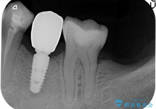 40代女性　奥歯のインプラント治療③～完成～の治療後