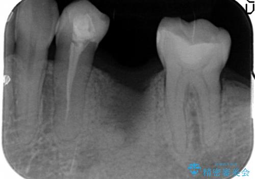 40代女性　奥歯のインプラント治療①～抜歯～の治療前