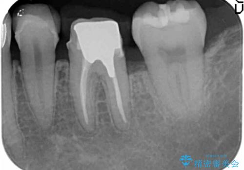 深い虫歯と銀歯をきれいなセラミックにの治療中