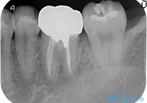 深い虫歯と銀歯をきれいなセラミックにの治療前