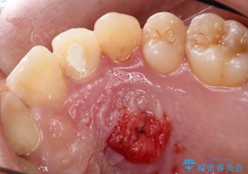 20代女性　前歯の不良な詰め物から大きな病気へ→根本から治療