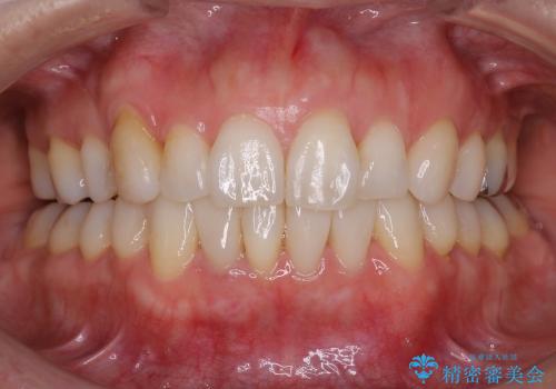 40代女性　下の前歯のセラミック修復の治療後