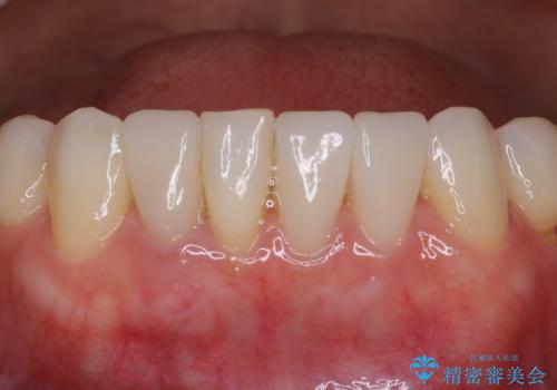40代女性　下の前歯のセラミック修復の症例 治療後