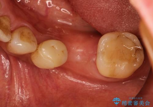40代女性　奥歯のインプラント治療②～インプラントの埋入～の治療前