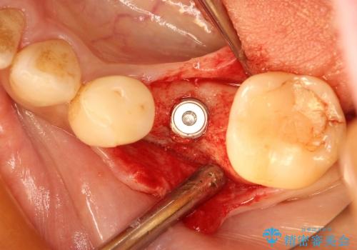 40代女性　奥歯のインプラント治療②～インプラントの埋入～の治療中