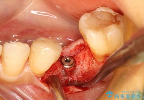 40代女性　奥歯のインプラント治療②～インプラントの埋入～の治療中