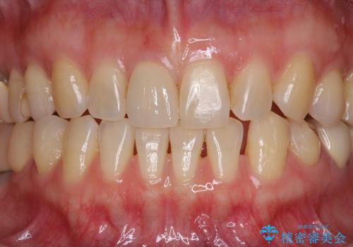 前歯のオールセラミッククラウン　特徴的な色調を再現の治療後
