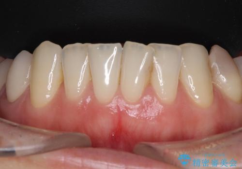 虫歯がたくさん　歯肉深くにまで及んだ虫歯の治療の治療後