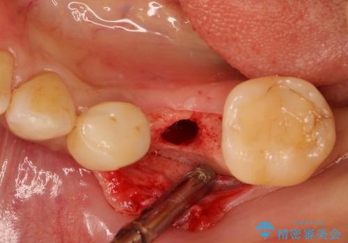 40代女性　奥歯のインプラント治療①～抜歯～