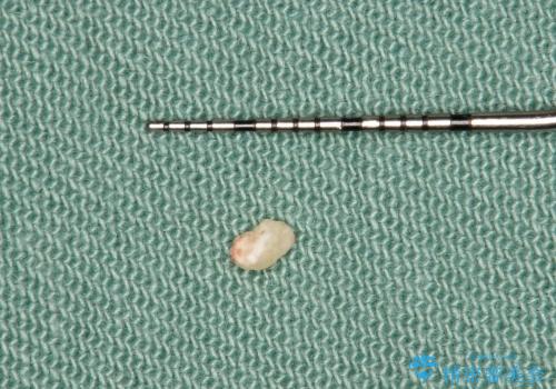 40代女性　奥歯のインプラント治療①～抜歯～の治療中