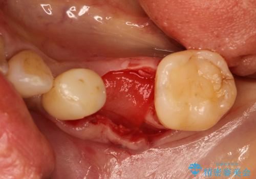 40代女性　奥歯のインプラント治療①～抜歯～の治療中