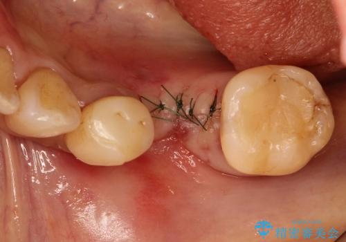 40代女性　奥歯のインプラント治療①～抜歯～の治療後