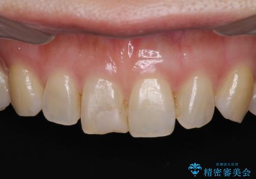 前歯のオールセラミッククラウン　特徴的な色調を再現
