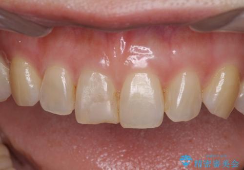 前歯のオールセラミッククラウン　特徴的な色調を再現の治療前