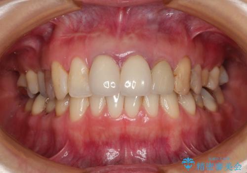 虫歯がたくさん　歯肉深くにまで及んだ虫歯の治療