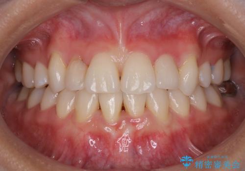 20代女性　前歯の不良な詰め物から大きな病気へ→根本から治療の治療後