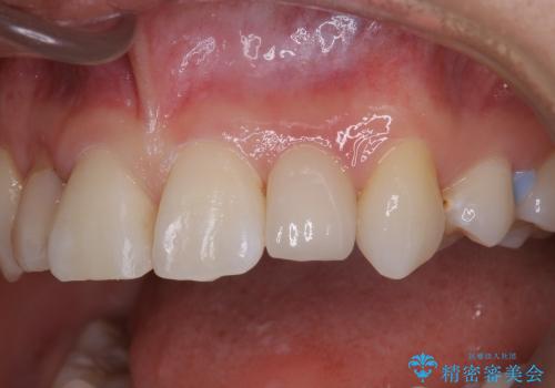 20代女性　前歯の不良な詰め物から大きな病気へ→根本から治療の症例 治療後