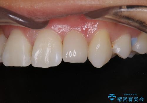 20代女性　前歯の不良な詰め物から大きな病気へ→根本から治療の治療後
