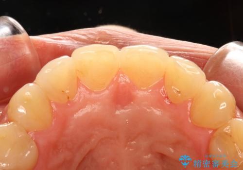 30代女性　前歯のねじれだけ部分矯正の治療後