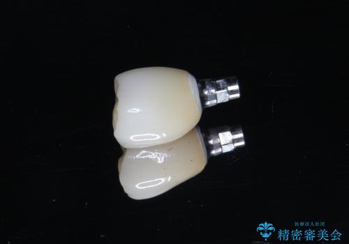 40代女性　奥歯のインプラント治療③～完成～