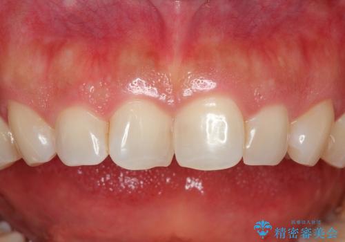 30代女性　前歯のねじれだけ部分矯正の症例 治療前