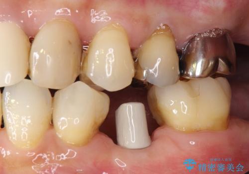 40代女性　奥歯のインプラント治療③～完成～の治療中