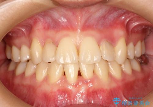 20代女性　前歯の不良な詰め物から大きな病気へ→根本から治療の治療前