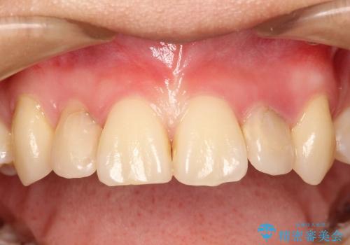 20代女性　前歯の不良な詰め物から大きな病気へ→根本から治療の治療前