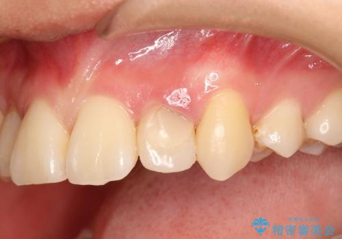 20代女性　前歯の不良な詰め物から大きな病気へ→根本から治療の症例 治療前