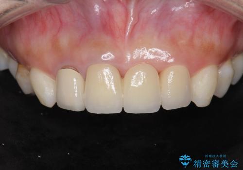 [前歯の審美回復] 前歯の入れ歯をオールセラミックブリッジへの症例 治療後