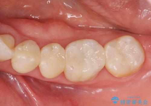 [セラミックインレー] 銀歯を白くする虫歯治療の症例 治療後