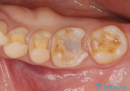 [セラミックインレー] 銀歯を白くする虫歯治療の治療中