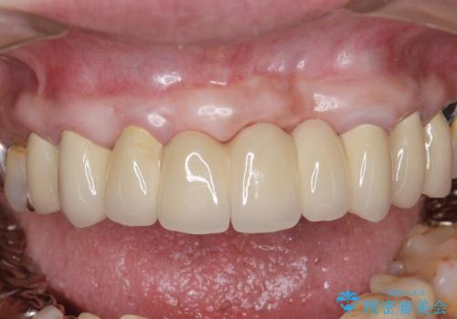 [歯周ポケット除去]  歯周病を改善してからの前歯部ブリッジの症例 治療後