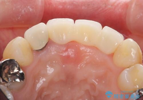 [前歯の審美回復] 前歯の入れ歯をオールセラミックブリッジへの治療後