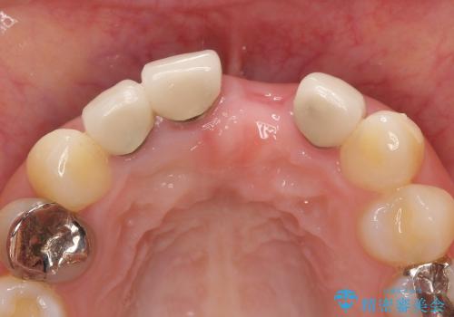 [前歯の審美回復] 前歯の入れ歯をオールセラミックブリッジへの治療中