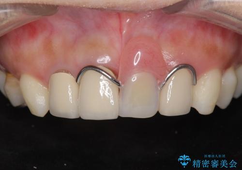 [前歯の審美回復] 前歯の入れ歯をオールセラミックブリッジへの治療前